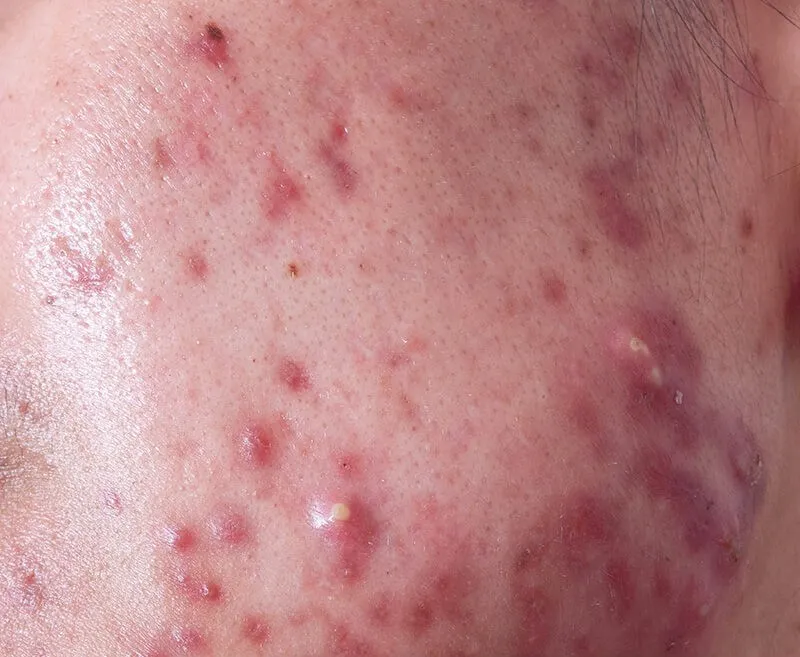 Acne