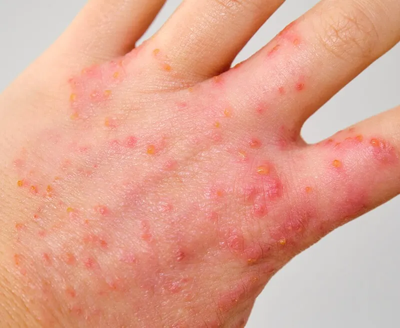 Eczema