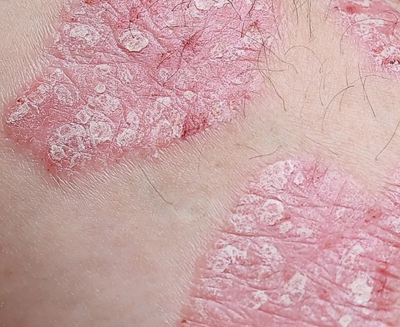 Psoriasis