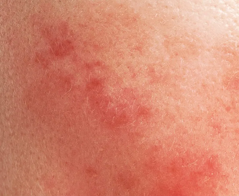 Rosacea