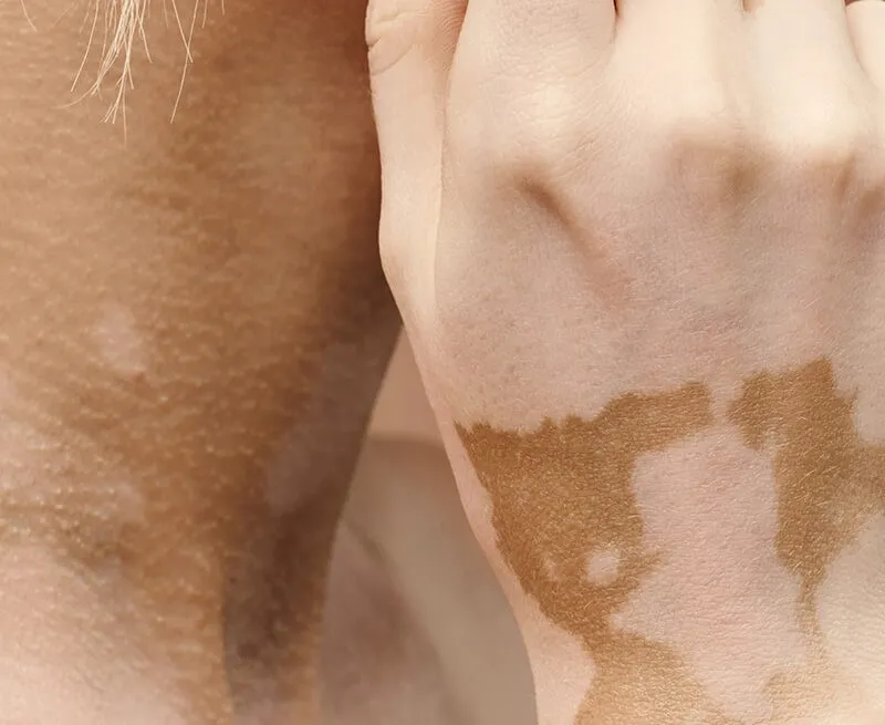 Vitiligo