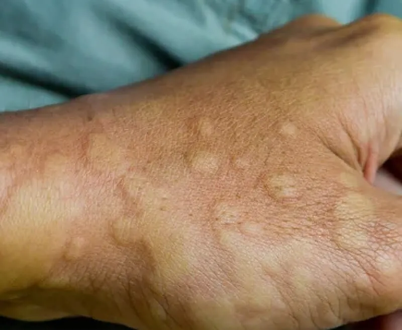 Hives
