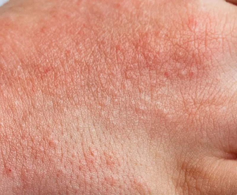 Skin Infections