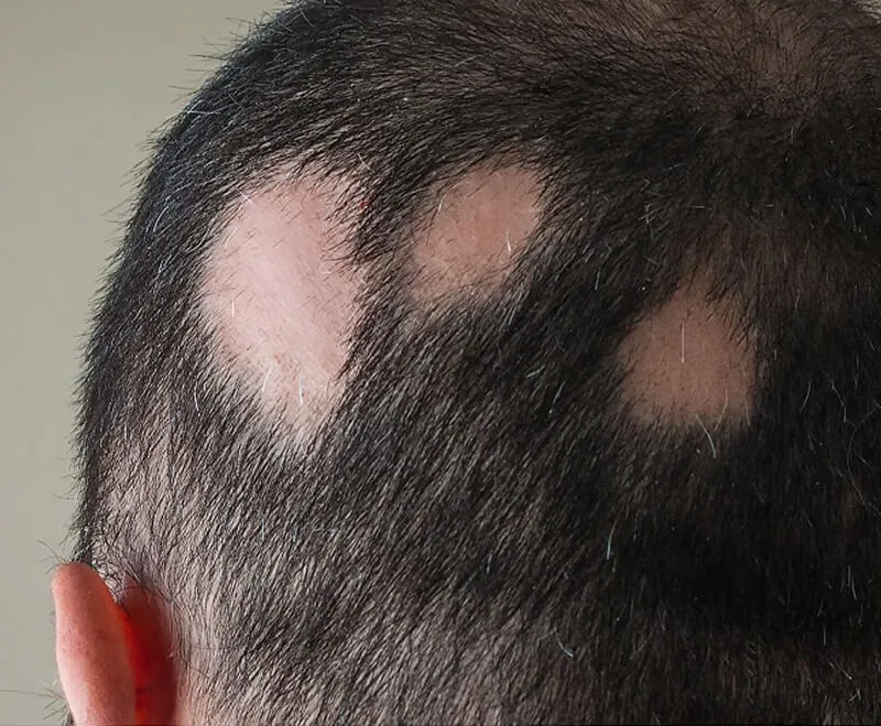 Hair Loss