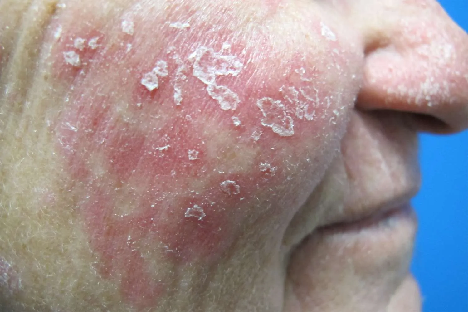Rosacea