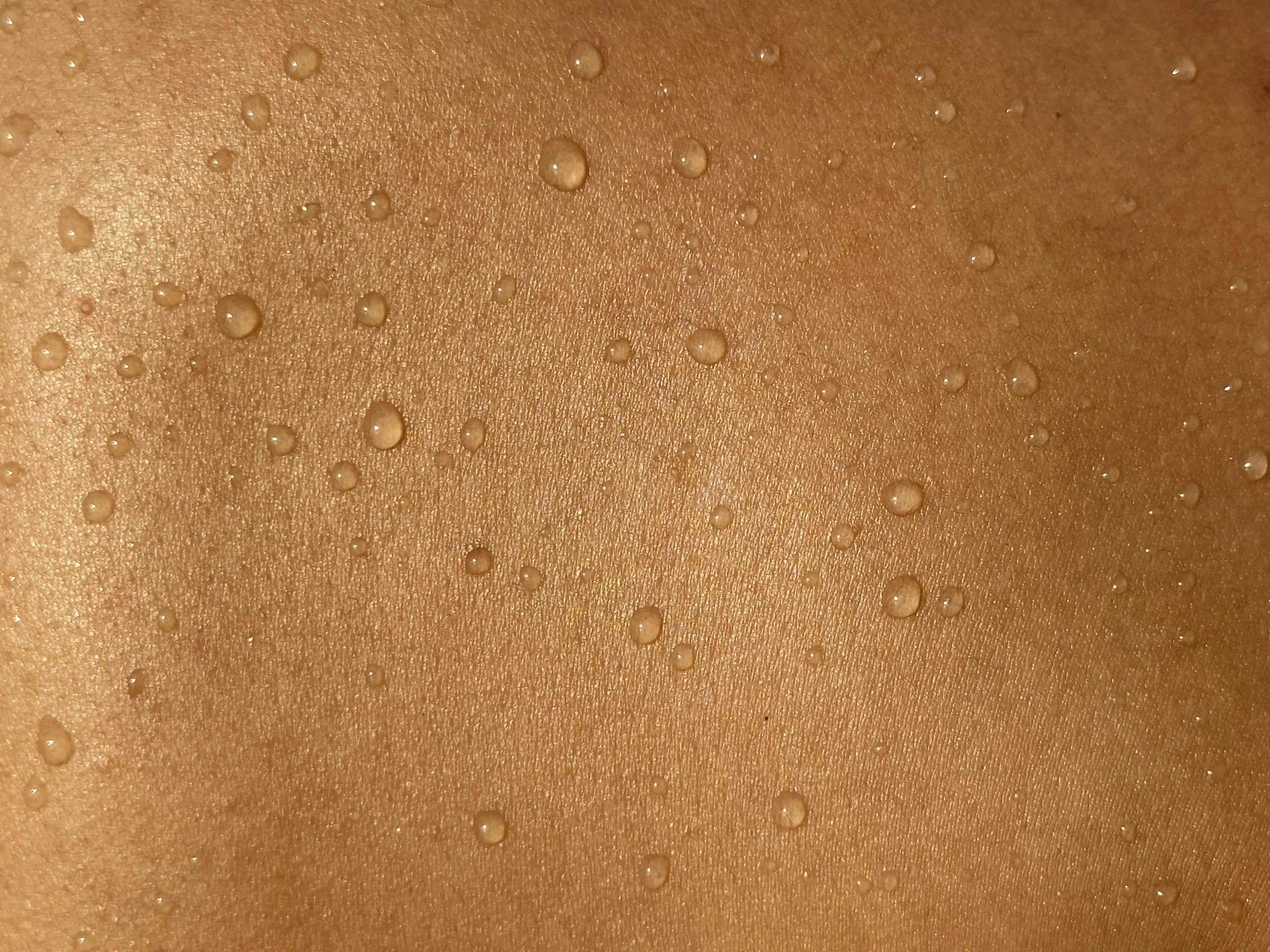 Rosacea