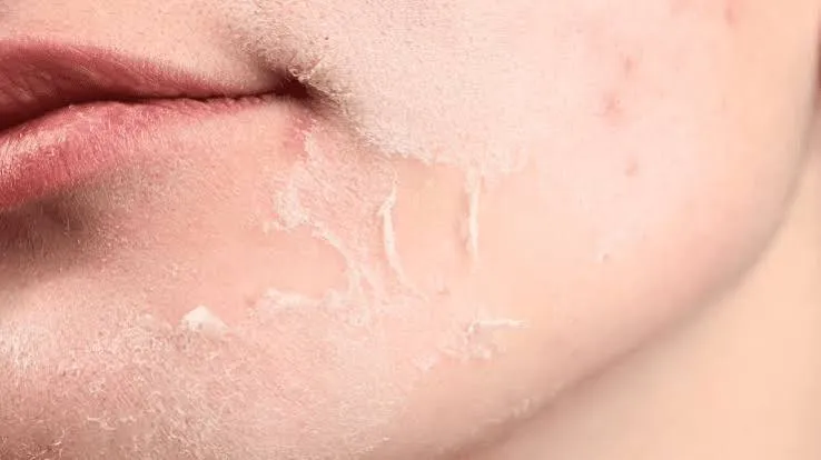 Skin Infections