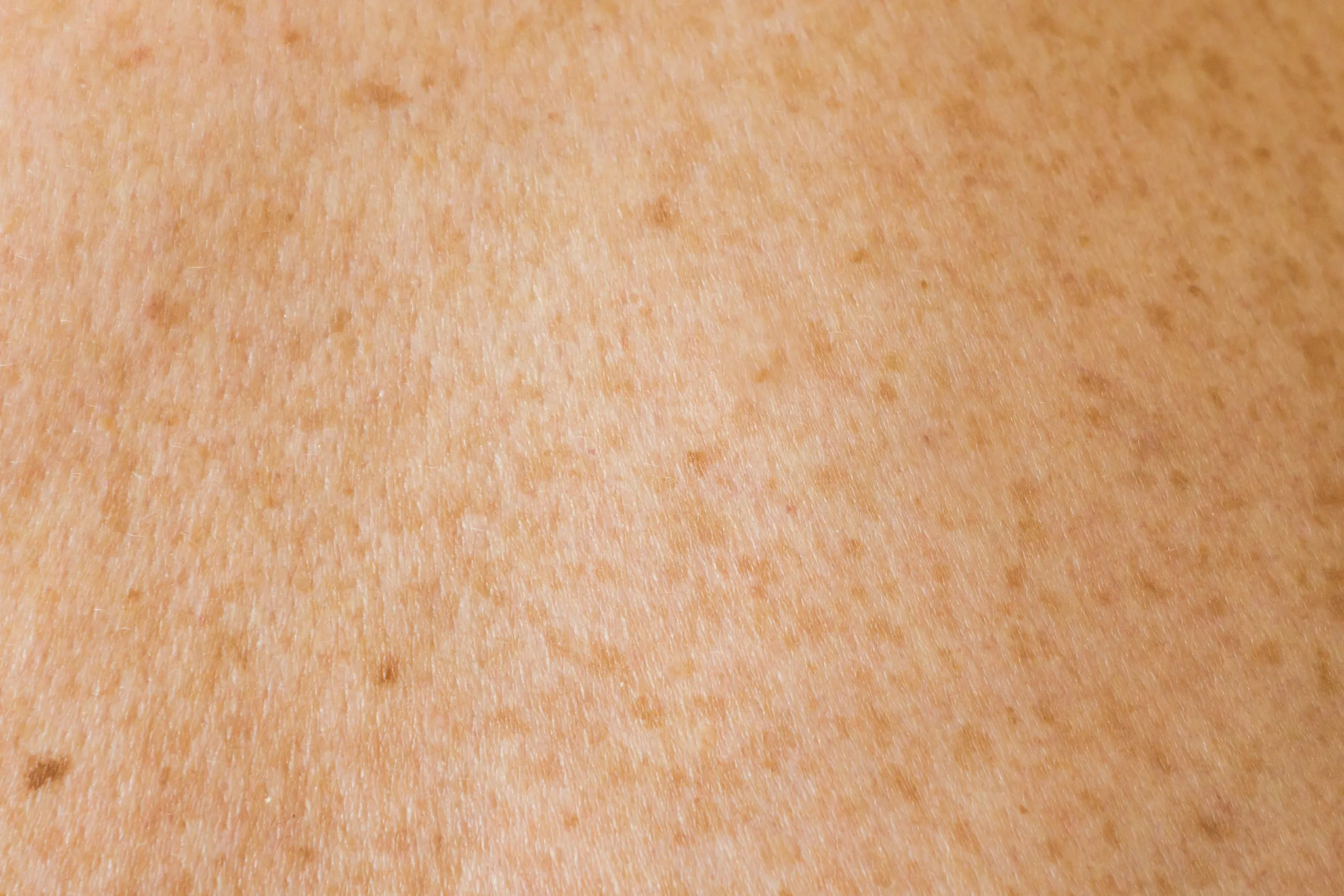 Rosacea