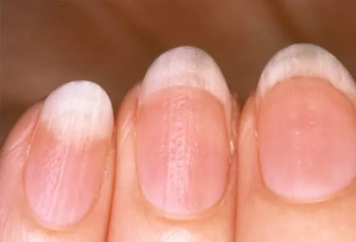 Close-up of pitted nails showing skin condition.
