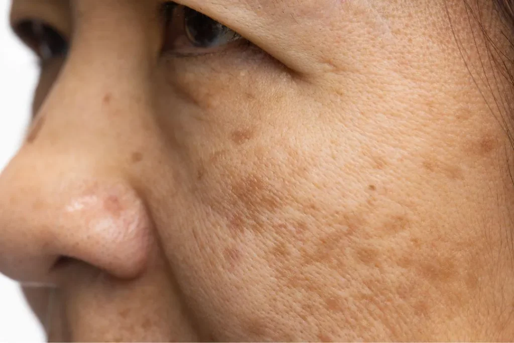 Illustration explaining causes of pigmentation and dark spots.